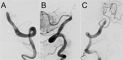 Association of Regular Thrombus Surface Phenotype With Complete Recanalization in First-Line Contact Aspiration Thrombectomy for Basilar Artery Occlusion